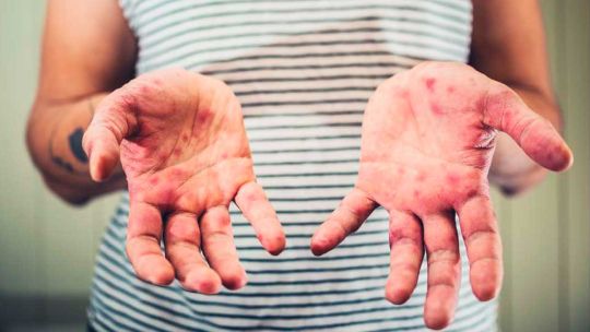 Casos de sarampión en el AMBA: cuáles son los síntomas